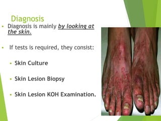 Diagnosis
 Diagnosis is mainly by looking at
the skin.
 If tests is required, they consist:
 Skin Culture
 Skin Lesion Biopsy
 Skin Lesion KOH Examination.
10
 