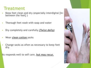 Treatment
 Keep feet clean and dry (especially interdigital [in-
between the feet] )
 Thorough feet wash with soap and water
 Dry completely and carefully (Twice daily)
 Wear clean cotton socks
 Change socks as often as necessary to keep feet
dry.
Its responds well to self care, but may recur.
12
 