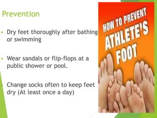 Prevention
 Dry feet thoroughly after bathing
or swimming
 Wear sandals or flip-flops at a
public shower or pool.
 Change socks often to keep feet
dry (At least once a day)
15
 
