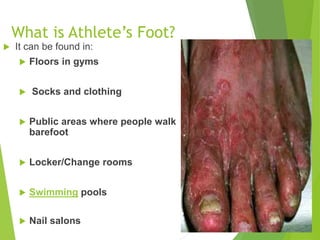 What is Athlete’s Foot?
 It can be found in:
 Floors in gyms
 Socks and clothing
 Public areas where people walk
barefoot
 Locker/Change rooms
 Swimming pools
 Nail salons 3
 