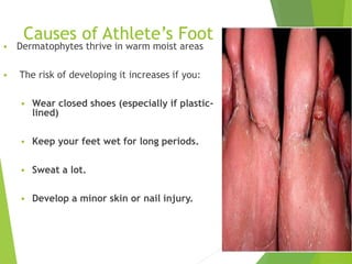 Causes of Athlete’s Foot
 Dermatophytes thrive in warm moist areas
 The risk of developing it increases if you:
 Wear closed shoes (especially if plastic-
lined)
 Keep your feet wet for long periods.
 Sweat a lot.
 Develop a minor skin or nail injury.
5
 