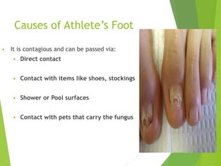 Causes of Athlete’s Foot
 It is contagious and can be passed via:
 Direct contact
 Contact with items like shoes, stockings
 Shower or Pool surfaces
 Contact with pets that carry the fungus
6
 