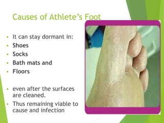 Causes of Athlete’s Foot
 It can stay dormant in:
 Shoes
 Socks
 Bath mats and
 Floors
 even after the surfaces
are cleaned.
 Thus remaining viable to
cause and infection 7
 