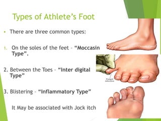 Types of Athlete’s Foot
 There are three common types:
1. On the soles of the feet – “Moccasin
Type”.
2. Between the Toes – “Inter digital
Type”
3. Blistering – “Inflammatory Type”
It May be associated with Jock itch. 8
 