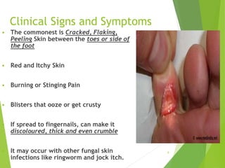 Clinical Signs and Symptoms
 The commonest is Cracked, Flaking,
Peeling Skin between the toes or side of
the foot
 Red and Itchy Skin
 Burning or Stinging Pain
 Blisters that ooze or get crusty
 If spread to fingernails, can make it
discoloured, thick and even crumble
 It may occur with other fungal skin
infections like ringworm and jock itch.
9
 