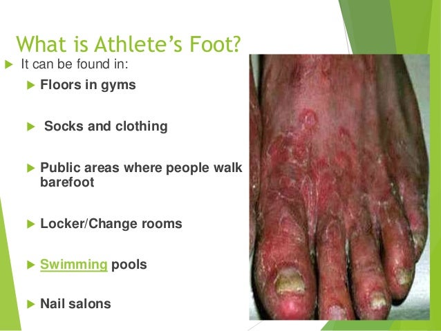 athletes foot slides