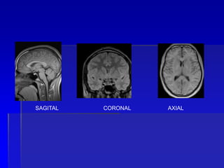 SAGITAL CORONAL AXIAL
 