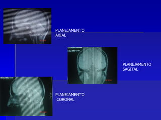 PLANEJAMENTO
SAGITAL
PLANEJAMENTO
AXIAL
PLANEJAMENTO
CORONAL
 