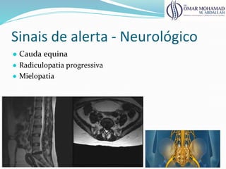 Sinais de alerta - Neurológico
● Cauda equina
● Radiculopatia progressiva
● Mielopatia
 