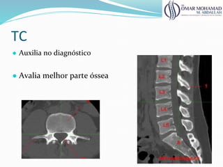 TC
● Auxilia no diagnóstico
● Avalia melhor parte óssea
60
 
