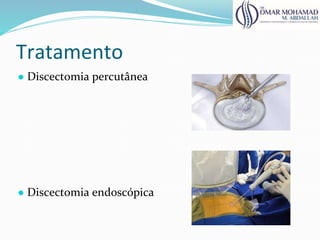 Tratamento
● Discectomia percutânea
● Discectomia endoscópica
 