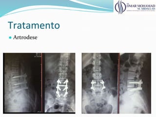 Tratamento
● Artrodese
 