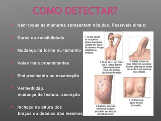  Nem todas as mulheres apresentam nódulos. Possíveis sinais:
 Dores ou sensibilidade
 Mudança na forma ou tamanho
 Veias mais proeminentes
 Endurecimento ou escamação
 Vermelhidão,
mudança de textura, secreção
 Inchaço na altura dos
braços ou debaixo dos mesmos.
 
