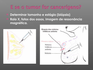  Determinar tamanho e estágio (biópsia)
 Raio X, fotos dos ossos, imagem de ressonância
magnética.
 