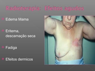  Edema Mama
 Eritema,
descamação seca
 Fadiga
 Efeitos dermicos
 