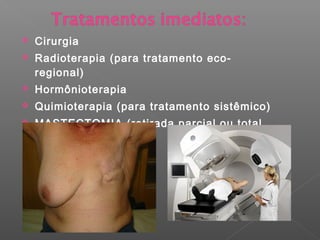  Cirurgia
 Radioterapia (para tratamento eco-
regional)
 Hormônioterapia
 Quimioterapia (para tratamento sistêmico)
 MASTECTOMIA (retirada parcial ou total
da mama)
 