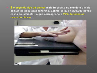  É o segundo tipo de câncer mais freqüente no mundo e o mais
comum na população feminina. Estima-se que 1.200.000 novos
casos anualmente,, o que corresponde a 22% de todos os
casos de câncer.
 