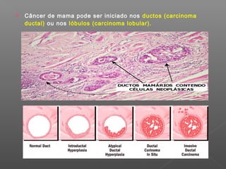  Câncer de mama pode ser iniciado nos ductos (carcinoma
ductal) ou nos lóbulos (carcinoma lobular).
 