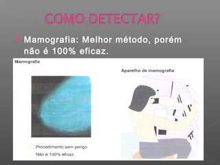    Mamografia: Melhor método, porém
    não é 100% eficaz.
 