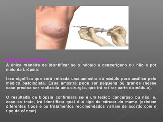 Biópsia da Mama
A única maneira de identificar se o nódulo é cancerígeno ou não é por
meio da biópsia.

Isso significa que será retirada uma amostra do nódulo para análise pelo
médico patologista. Essa amostra pode ser pequena ou grande (nesse
caso precisa ser realizada uma cirurgia, que irá retirar parte do nódulo).

O resultado da biópsia confirmara se é um tecido canceroso ou não, e,
caso se trate, irá identificar qual é o tipo de câncer de mama (existem
diferentes tipos e os tratamentos recomendados variam de acordo com o
tipo de câncer).
 
