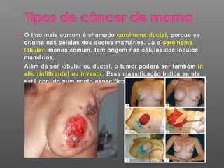    O tipo mais comum é chamado carcinoma ductal, porque se
    origina nas células dos ductos mamários. Já o carcinoma
    lobular, menos comum, tem origem nas células dos lóbulos
    mamários.
   Além de ser lobular ou ductal, o tumor poderá ser também in
    situ (infiltrante) ou invasor. Essa classificação indica se ele
    está contido num ponto específico da mama ou se já começou
    a se espalhar pelo órgão.
 