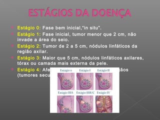    Estágio 0: Fase bem inicial,“in situ”.
   Estágio 1: Fase inicial, tumor menor que 2 cm, não
    invade a área do seio.
   Estágio 2: Tumor de 2 a 5 cm, nódulos linfáticos da
    região axilar.
   Estágio 3: Maior que 5 cm, nódulos linfáticos axilares,
    tórax ou camada mais externa da pele.
   Estágio 4: Afeta nódulos e atinge outros órgãos
    (tumores secundários).
 