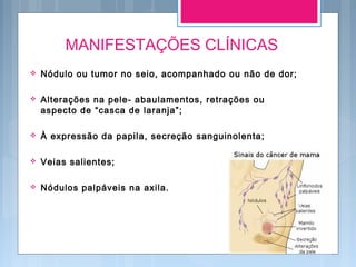 MANIFESTAÇÕES CLÍNICAS
 Nódulo ou tumor no seio, acompanhado ou não de dor;
 Alterações na pele- abaulamentos, retrações ou
aspecto de “casca de laranja”;
 À expressão da papila, secreção sanguinolenta;
 Veias salientes;
 Nódulos palpáveis na axila.
 