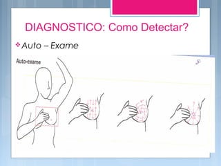 DIAGNOSTICO: Como Detectar?
Auto – Exame
 