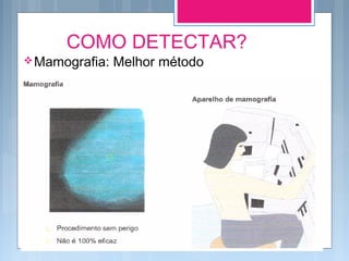 COMO DETECTAR?
Mamografia: Melhor método, porém não é
100% eficaz.
 