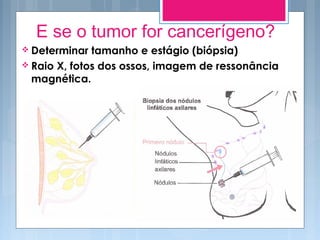 E se o tumor for cancerígeno?
 Determinar tamanho e estágio (biópsia)
 Raio X, fotos dos ossos, imagem de ressonância
magnética.
 