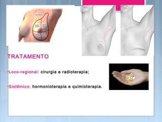 TRATAMENTOalguma g
•Loco-regional: cirurgia e radioterapia;
•Sistêmico: hormonioterapia e quimioterapia.
 