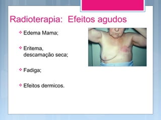 Radioterapia: Efeitos agudos
 Edema Mama;
 Eritema,
descamação seca;
 Fadiga;
 Efeitos dermicos.
 