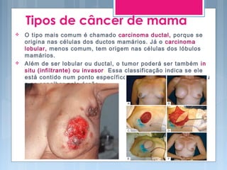 Tipos de câncer de mama
 O tipo mais comum é chamado carcinoma ductal, porque se
origina nas células dos ductos mamários. Já o carcinoma
lobular, menos comum, tem origem nas células dos lóbulos
mamários.
 Além de ser lobular ou ductal, o tumor poderá ser também in
situ (infiltrante) ou invasor. Essa classificação indica se ele
está contido num ponto específico da mama ou se já começou
a se espalhar pelo órgão.
 