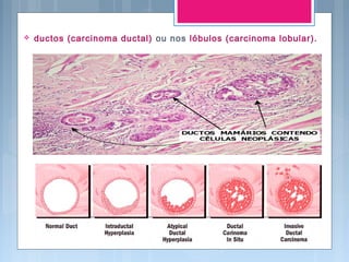  ductos (carcinoma ductal) ou nos lóbulos (carcinoma lobular).
 