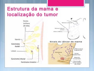 Estrutura da mama e
localização do tumor
 