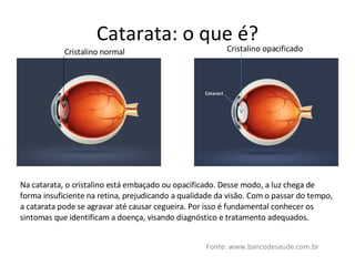 Catarata: o que é? Fonte: www.bancodesaude.com.br Cristalino normal Cristalino opacificado Na catarata, o cristalino está embaçado ou opacificado. Desse modo, a luz chega de forma insuficiente na retina, prejudicando a qualidade da visão. Com o passar do tempo, a catarata pode se agravar até causar cegueira. Por isso é fundamental conhecer os sintomas que identificam a doença, visando diagnóstico e tratamento adequados. 