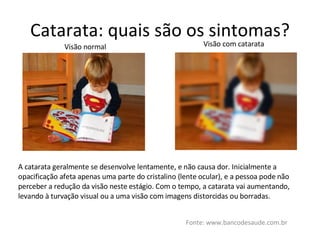 Catarata: quais são os sintomas? Fonte: www.bancodesaude.com.br Visão normal Visão com catarata A catarata geralmente se desenvolve lentamente, e não causa dor. Inicialmente a opacificação afeta apenas uma parte do cristalino (lente ocular), e a pessoa pode não perceber a redução da visão neste estágio. Com o tempo, a catarata vai aumentando, levando à turvação visual ou a uma visão com imagens distorcidas ou borradas. 