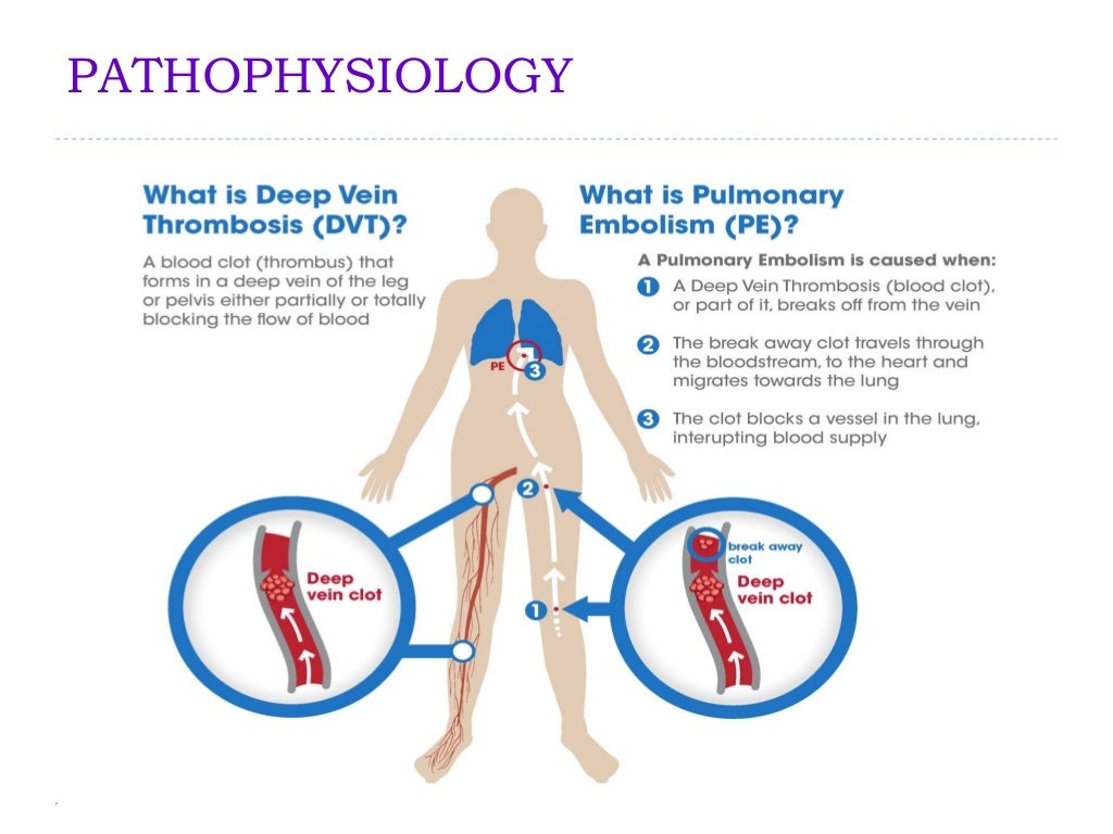 CPG Prevention and Treatment of Venous Thromboembolism (VTE)