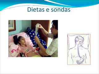 Dietas e sondas
 