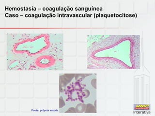 Hemostasia – coagulação sanguínea
Caso – coagulação intravascular (plaquetocitose)
Fonte: própria autoria
 