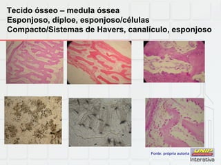 Tecido ósseo – medula óssea
Esponjoso, díploe, esponjoso/células
Compacto/Sistemas de Havers, canalículo, esponjoso
Fonte: própria autoria
 
