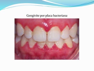 Gengivite por placa bacteriana
 