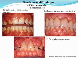 a b
c
(c) Por um imunossupressor.
c
Gengivite modificada por :
efeitos hormonais.
medicamentos.
(a) pelos efeitos hormonais da
gravidez.
(b) Por um fármaco anti-hipertensivo
c
Australian Dental Journal 2009; 54:(1 Suppl): S11–S26
 
