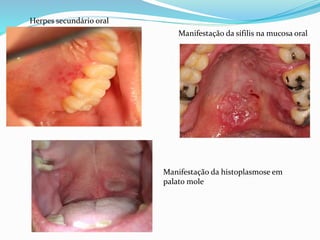 Herpes secundário oral
Manifestação da sífilis na mucosa oral
Manifestação da histoplasmose em
palato mole
 