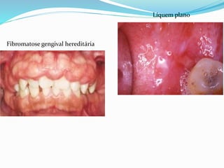 Líquem plano
Fibromatose gengival hereditária
 