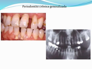 Periodontite crônica generalizada
 