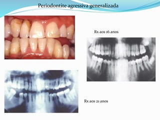 Periodontite agressiva generalizada
Rx aos 16 anos
Rx aos 21 anos
 