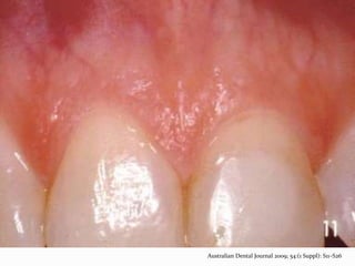 Australian Dental Journal 2009; 54:(1 Suppl): S11–S26
 