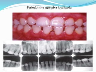 Periodontite agressiva localizada
 