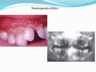 Neutropenia cíclica
 